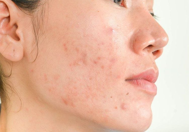 Chu Kỳ Kinh Nguyệt Ngắn Ra Máu Ít: 13 Nguyên Nhân Thường Gặp Và Khi Nào Cần Gặp Bác Sĩ 4 Thay đổi nội tiết tố do PCOS có thể dẫn đến các vấn đề như nổi mụn